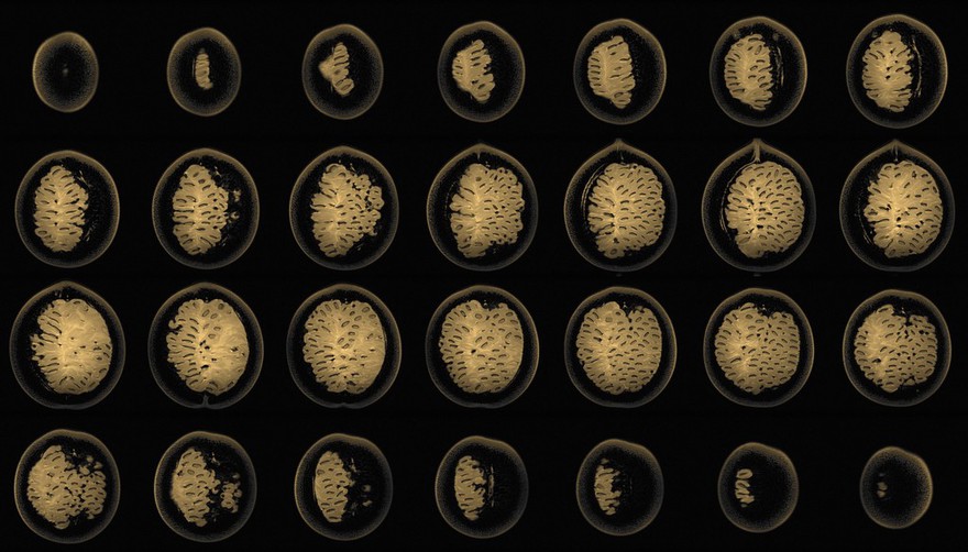 Granadilla, sagittal view, MRI