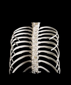 Ribcage, Hodgkin lymphoma patient, 3D printed nylon