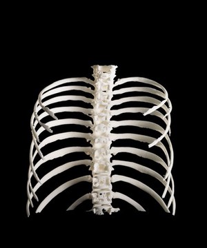 view Ribcage, Hodgkin lymphoma patient, 3D printed nylon