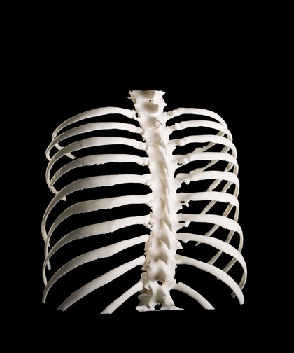 Ribcage, Hodgkin lymphoma patient, 3D printed nylon