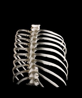 Ribcage, Hodgkin lymphoma patient, 3D printed nylon