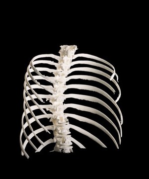 view Ribcage, Hodgkin lymphoma patient, 3D printed nylon