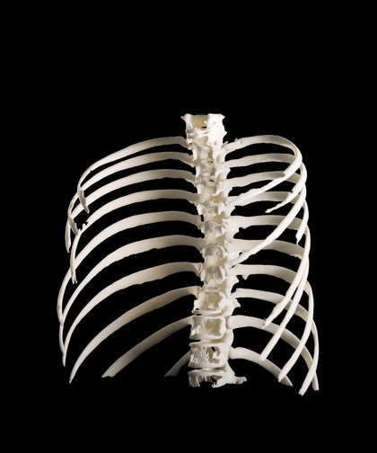 Ribcage, Hodgkin lymphoma patient, 3D printed nylon