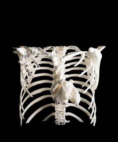 Heart in ribcage, Hodgkin lymphoma patient, 3D printed nylon