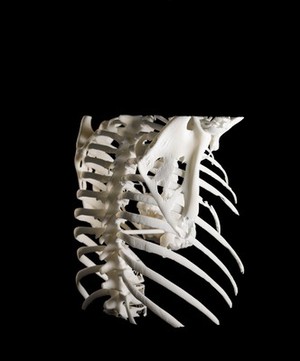 view Heart in ribcage, Hodgkin lymphoma patient, 3D printed nylon