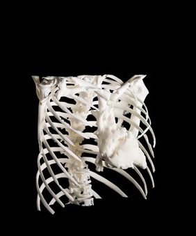 Heart in ribcage, Hodgkin lymphoma patient, 3D printed nylon