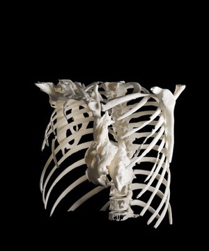 view Heart in ribcage, Hodgkin lymphoma patient, 3D printed nylon