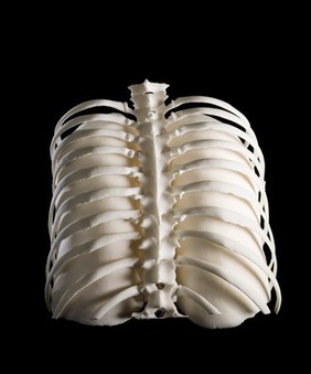 Lungs in ribcage, Hodgkin lymphoma patient, 3D printed nylon