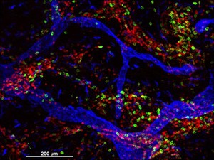 view Cellular architecture of normal human skin imaged by whole mount tissue microscopy. Human skin has a rich network of white blood cells (specifically dendritic cells, T cells and macrophages) which form sheaths around blood vessels (string-like structures). A network of lymphatic vessels (ribbon-like structures) is also present. In this image, human skin lymphatic vessels (stained for LYVE-1; blue) and white blood cells comprised of dendritic cells (stained for CD11c; green) and T cells (stained for CD3; red) can be seen. Some macrophages also express the protein LYVE-1 similar to lymphatic vessel cells which can be appreciated as blue cells within and in between the sheaths of white blood cells. This normal cellular architecture is grossly disrupted in diseased skin (see related images). X10 magnification. Scale bar (white) represents 200 micrometres.