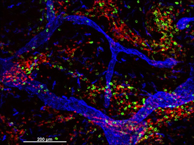 Cellular architecture of normal human skin imaged by whole mount tissue microscopy. Human skin has a rich network of white blood cells (specifically dendritic cells, T cells and macrophages) which form sheaths around blood vessels (string-like structures). A network of lymphatic vessels (ribbon-like structures) is also present. In this image, human skin lymphatic vessels (stained for LYVE-1; blue) and white blood cells comprised of dendritic cells (stained for CD11c; green) and T cells (stained for CD3; red) can be seen. Some macrophages also express the protein LYVE-1 similar to lymphatic vessel cells which can be appreciated as blue cells within and in between the sheaths of white blood cells. This normal cellular architecture is grossly disrupted in diseased skin (see related images). X10 magnification. Scale bar (white) represents 200 micrometres.