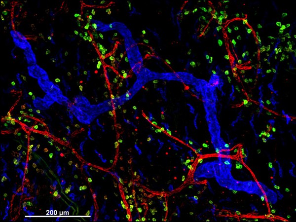 Cellular architecture of normal human skin imaged by whole mount tissue microscopy. Human skin has a rich network of white blood cells (specifically dendritic cells, T cells and macrophages) which form sheaths around blood vessels. In this image, blood vessels (string-like structures stained for CD31; red), lymphatic vessels (ribbon-like structures stained for LYVE-1; blue) and dendritic cells (stained for CD11c; green) can be seen. Macrophages (stained for LYVE-1; blue) are also present. This normal cellular architecture is grossly disrupted in diseased skin (see related images). X10 magnification. Scale bar (white) represents 200 micrometres.