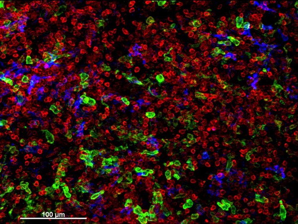 Cellular architecture of human skin lymphoma imaged by whole mount tissue microscopy. Normal human skin has a rich network of white blood cells (specifically dendritic cells, T cells and macrophages) which form sheaths around blood vessels. In diseased skin, such as in skin lymphoma as seen here, this normal architecture becomes distorted. In this image, lots of T cells (stained for CD3; red), dendritic cells (stained for CD11c; green) and macrophages (stained for LYVE-1; blue) have infiltrated the skin. X20 magnification. Scale bar (white) represents 100 micrometres.