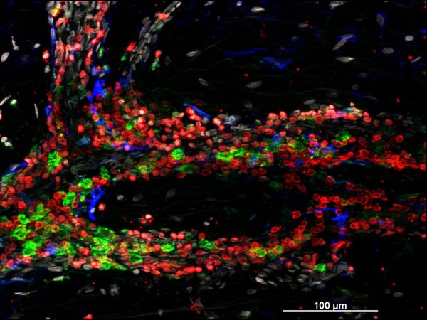 Cellular architecture of normal human skin imaged by whole mount tissue microscopy. Human skin has a rich network of white blood cells (specifically dendritic cells, T cells and macrophages) which form sheaths around blood vessels. In this image, T cells (stained for CD3; red) dendritic cells (stained for MHC class II; green) and macrophages (stained for LYVE-1; blue with some cells showing a tinge of green) can be seen. Cell nuclei have been stained with DAPI (grey). This normal cellular architecture is grossly disrupted in diseased skin (see related images). X20 magnification. Scale bar (white) represents 100 micrometres.