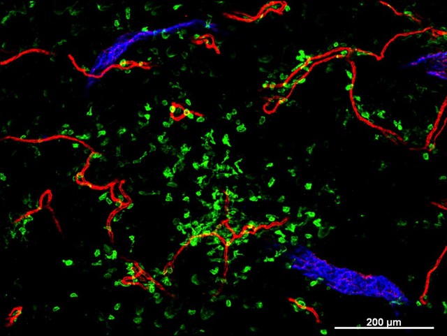 Cellular architecture of normal human skin imaged by whole mount tissue microscopy. Human skin has a rich network of white blood cells (specifically dendritic cells, T cells and macrophages) which form sheaths around blood vessels. This image was taken less than 20 micrometres beneath the junction that joins the dermal and epidermal layers of the skin (dermo-epidermal junction). At this level, dendritic cells (stained for CD11c; green) form clusters around and between blood capillary loops (stained for CD31; red). The blind-ended tips of initial lymphatic vessels are just visible (stained for LYVE-1; blue) at this level. This normal cellular architecture is grossly disrupted in diseased skin (see related images). Scale bar (white) represents 200 micrometres.