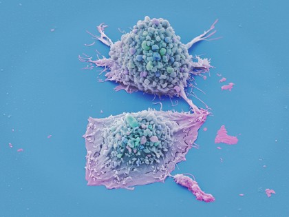 Lung cancer cells