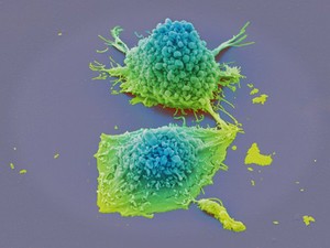 view Lung cancer cells