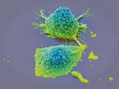 Lung cancer cells