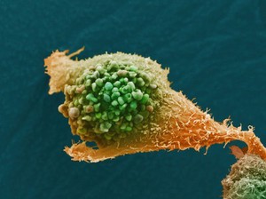 view Prostate cancer cell, SEM