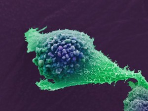 view Prostate cancer cell, SEM