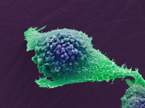 Prostate cancer cell, SEM