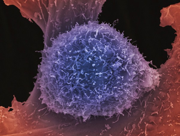 Prostate cancer cell, SEM