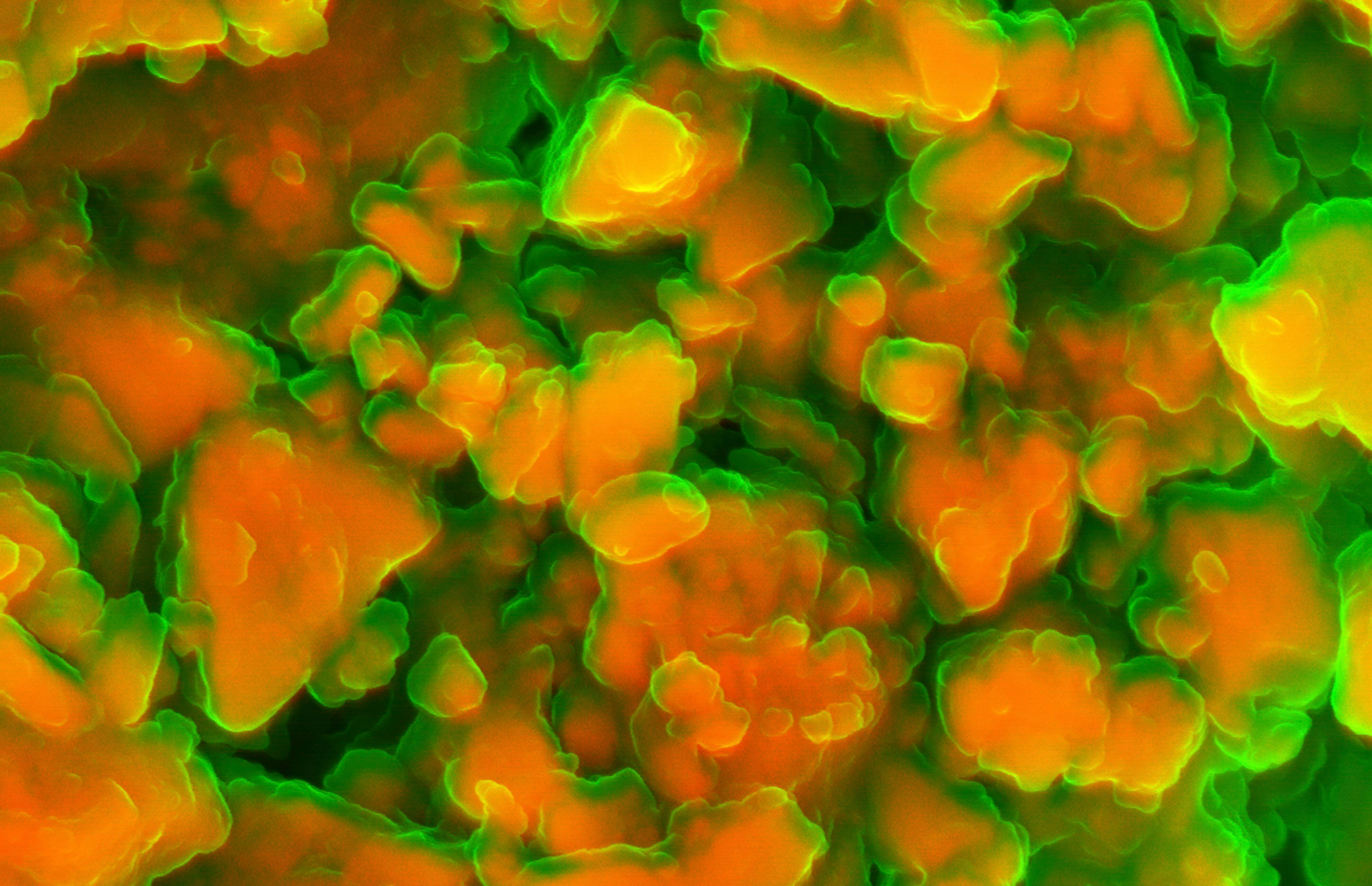 Kidney stone Collection