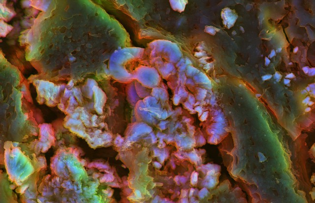 Kidney stone