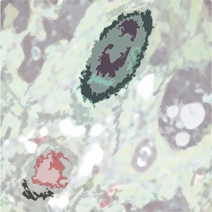 Venous invasion of colorectal cancer, modified histology