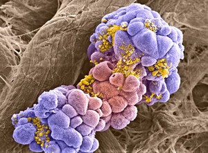 view Breast cancer cell spheroid treated with doxorubicin, SEM