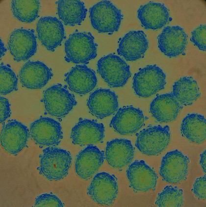 Prostate cancer cells treated with nano sized drug carriers