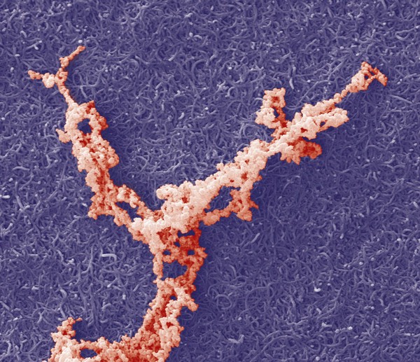 Carbon nanotubes (CNTs), cancer therapy, SEM