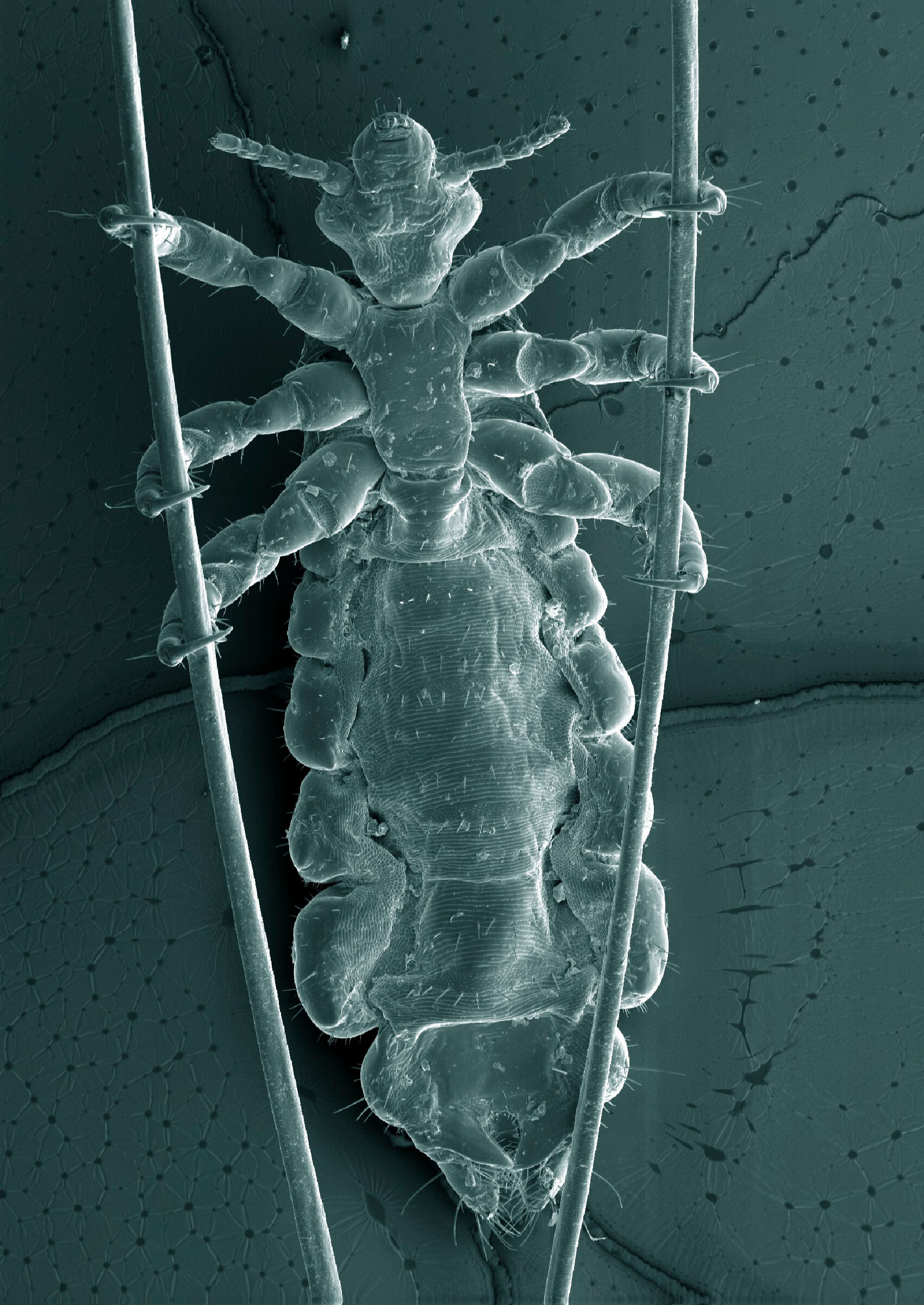 Head Louse Clinging Onto Strands Of Human Hair Sem Wellcome