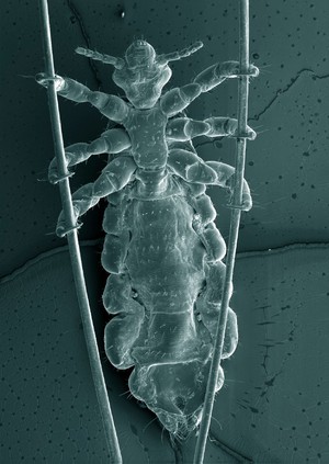 view Head louse clinging onto strands of human hair, SEM