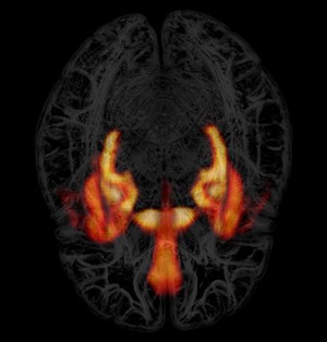 view Neurotransmitter in limbic areas of a human brain, PET