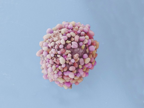 Breast cancer cell, SEM