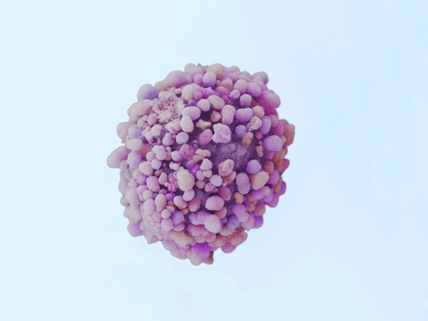Breast cancer cell, SEM