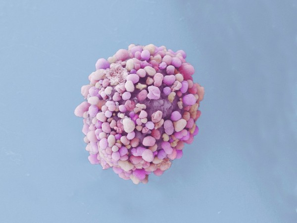 Breast cancer cell, SEM