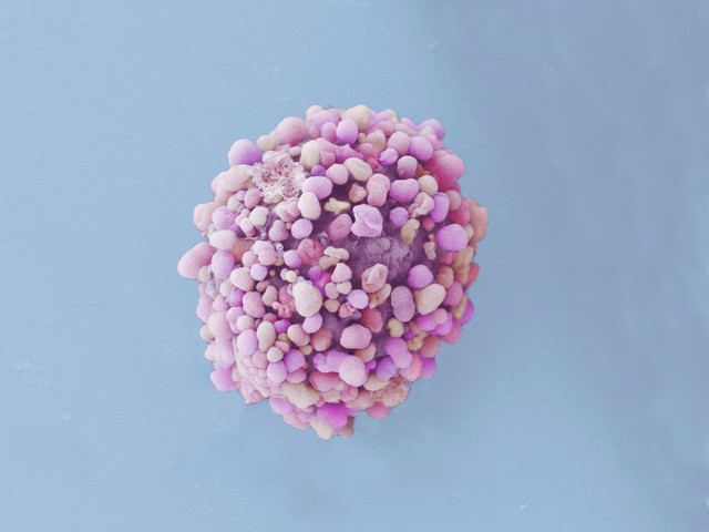Breast cancer cell, SEM