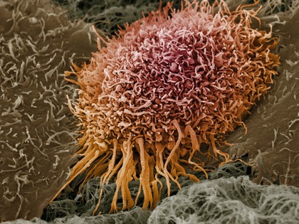 Human oral squamous cell carcinoma cell, SEM