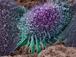 view Human oral squamous cell carcinoma cell, SEM