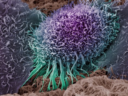 Human oral squamous cell carcinoma cell, SEM