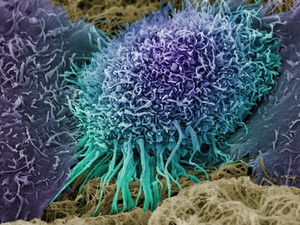 view Human oral squamous cell carcinoma cell, SEM