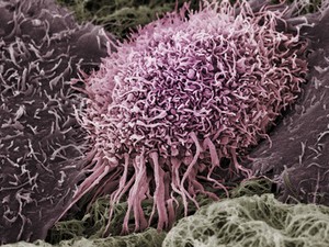 view Human oral squamous cell carcinoma cell, SEM