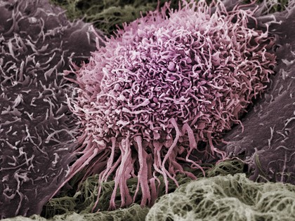 Human oral squamous cell carcinoma cell, SEM