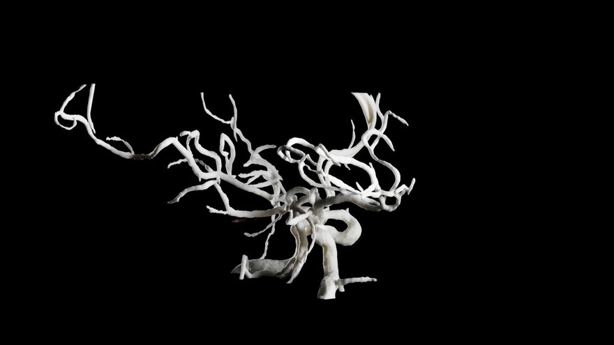 Brain blood vessels, suspected meningitis, 3D printed nylon