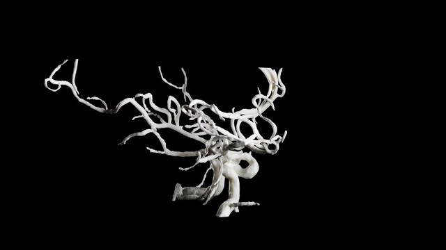 Brain blood vessels, suspected meningitis, 3D printed nylon
