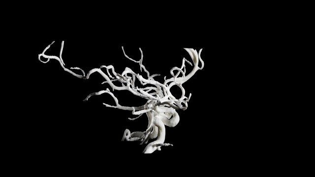 Brain blood vessels, suspected meningitis, 3D printed nylon