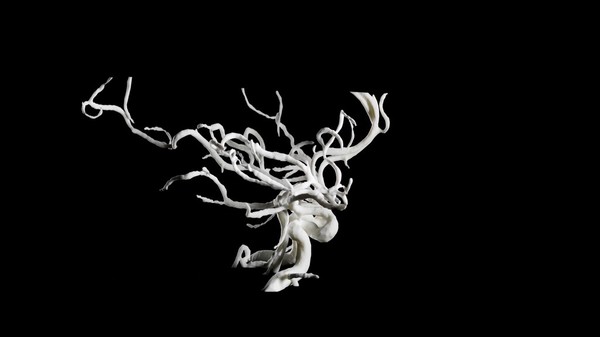 Brain blood vessels, suspected meningitis, 3D printed nylon