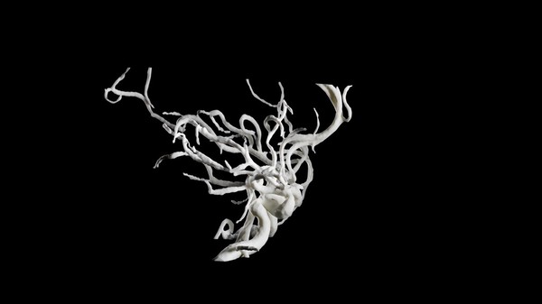 Brain blood vessels, suspected meningitis, 3D printed nylon