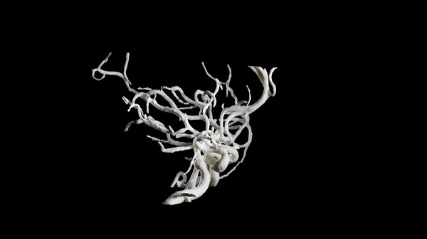 Brain blood vessels, suspected meningitis, 3D printed nylon